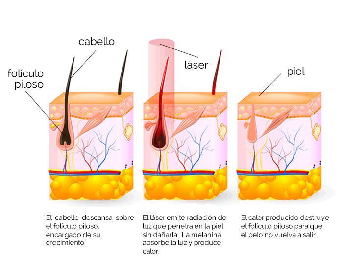 Depiladora Laser IPL®
